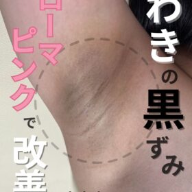 脇の黒ずみ改善アートメイク症例｜東京・恵比寿のアートメイク専門Art